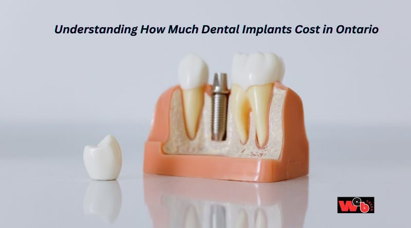 Understanding How Much Dental Implants Cost in Ontario